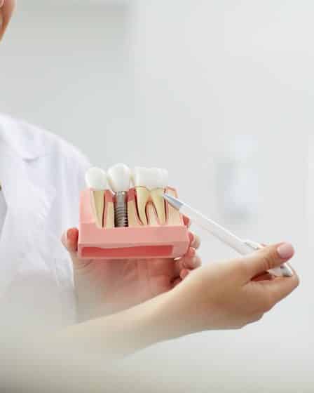 mantener implantes dentales