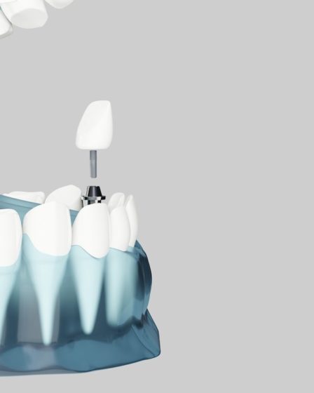 mitos y leyendas implantes dentales