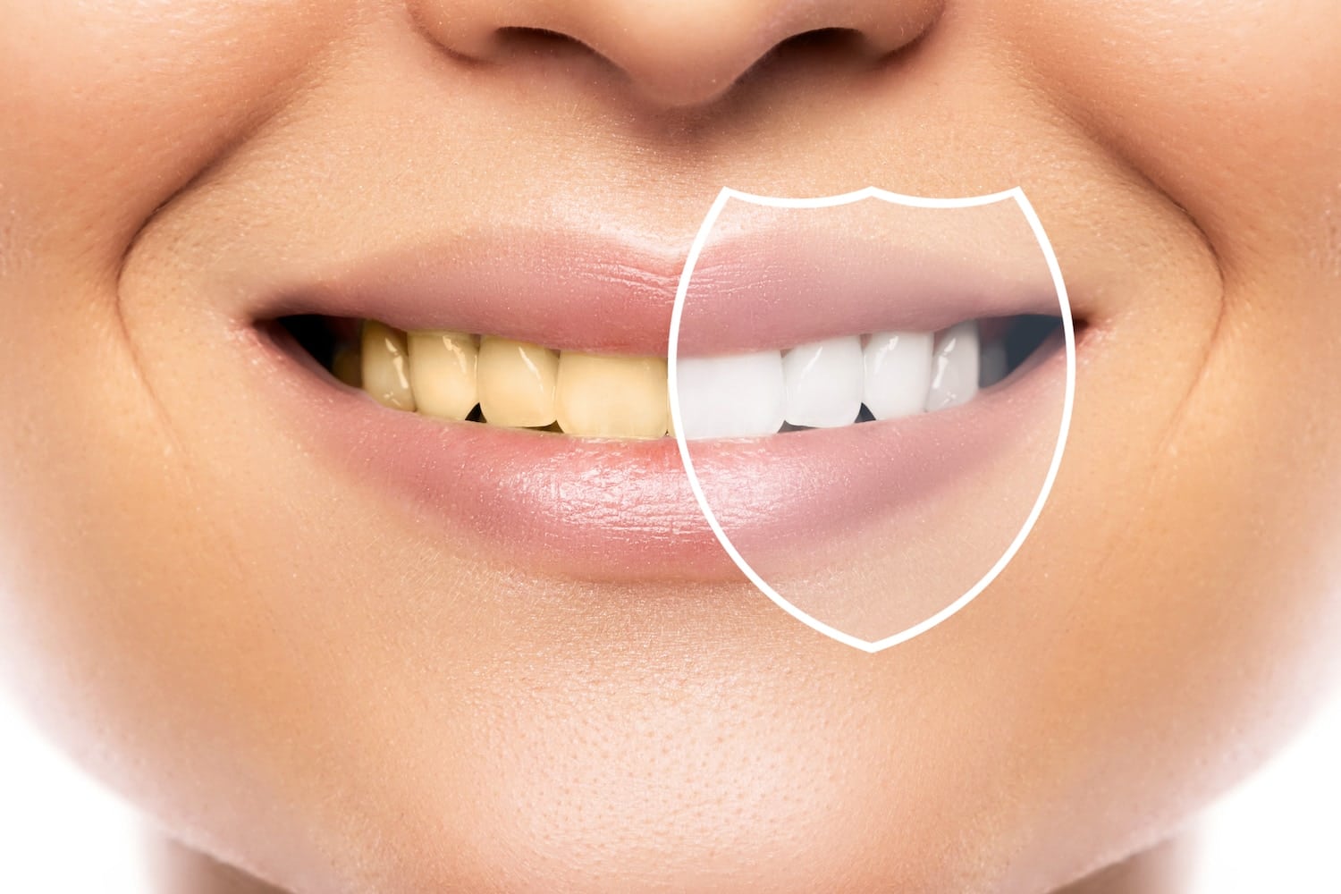mitos blanqueamiento dental